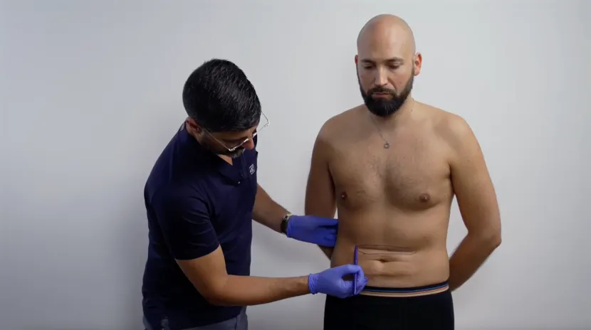 abdominal  skin folds treatment