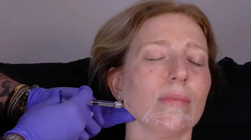 bove-chin-jawline-cover